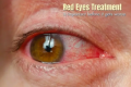Red Eyes Treatment
