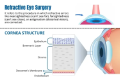 Refractive eye surgery