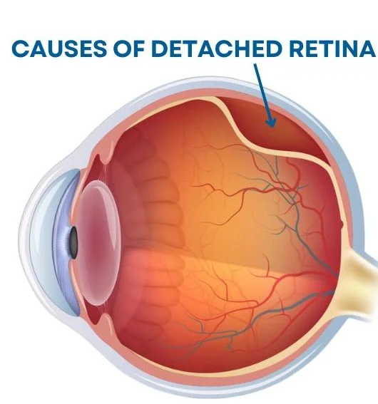 Causes of Retinal Detachment