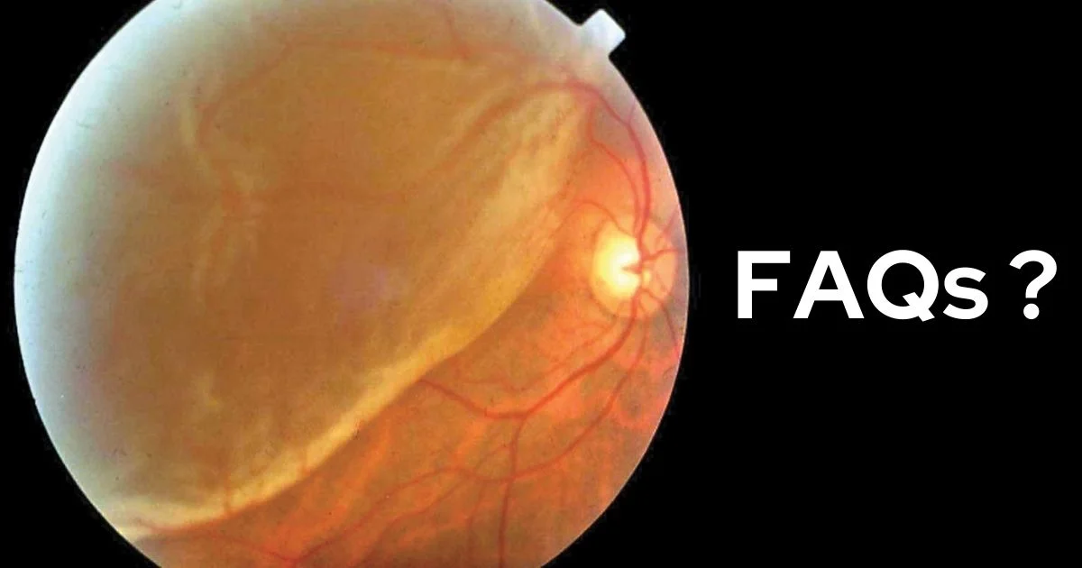Faqs Related To Retinal Detachments
