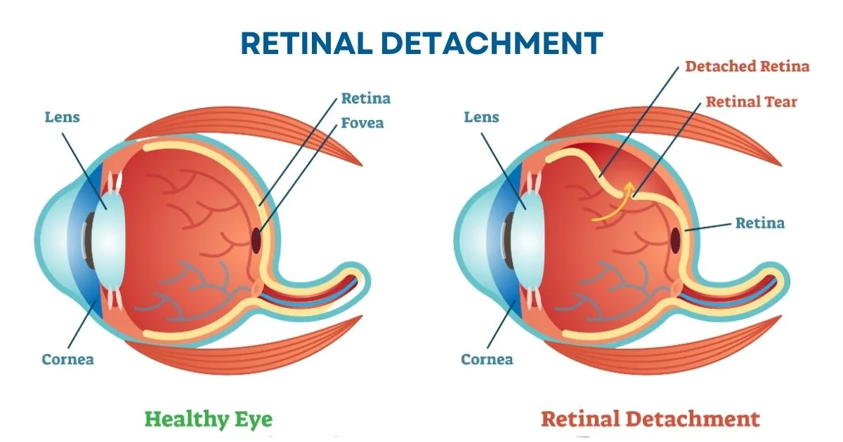 Retinal Detachment Treatment In Delhi