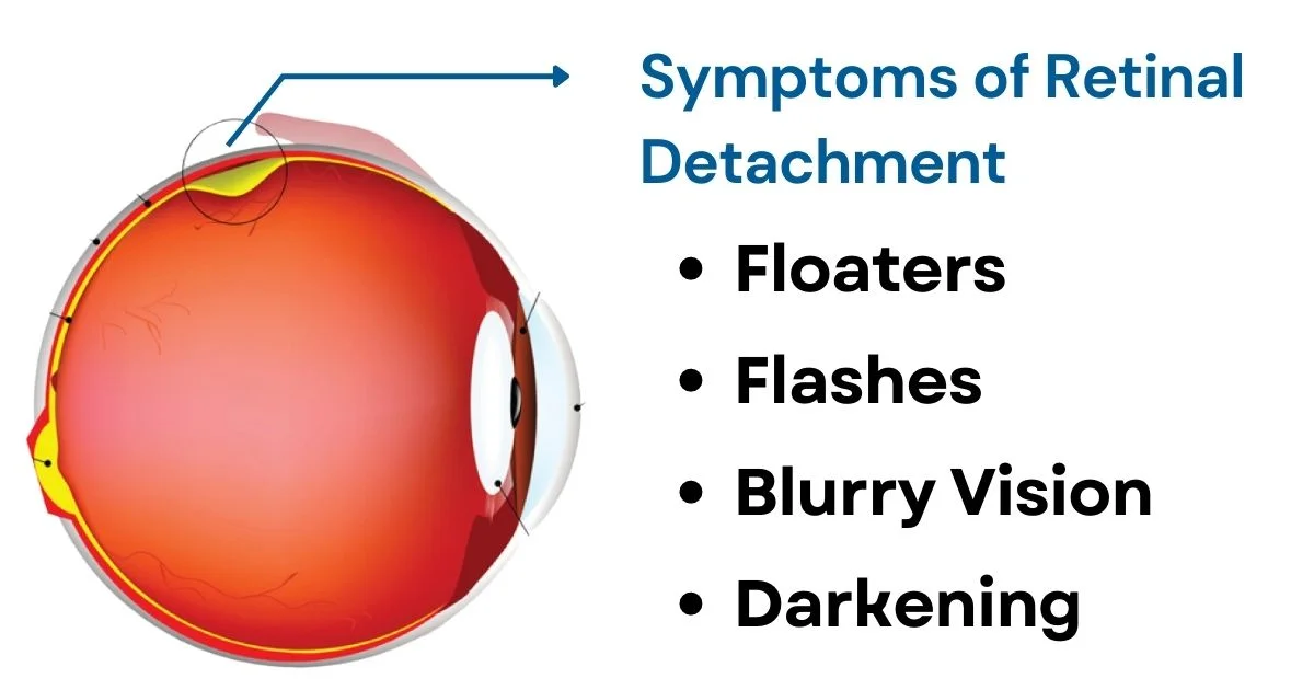 Symptoms Of Retinal Detachment