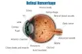 Retinal hemorrhage