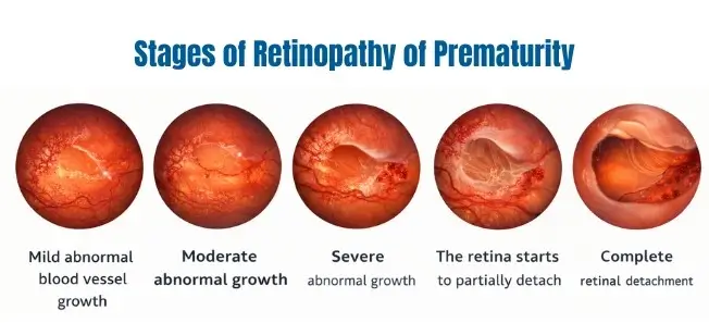 Stages of retinopathy of prematurity