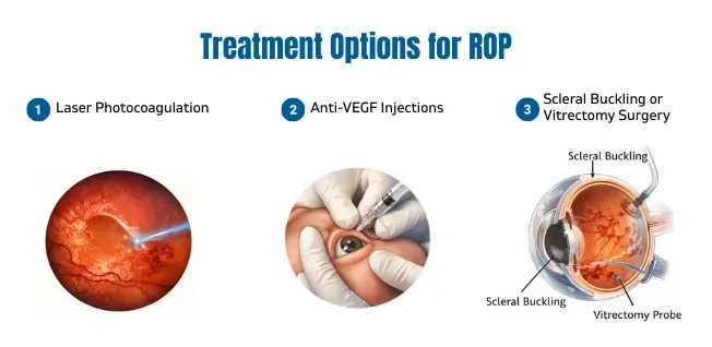 Treatment of rop