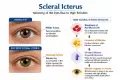 Scleral Icterus