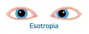 Squint esotropia