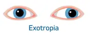 Squint exotropia