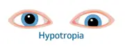 Squint hypertropia