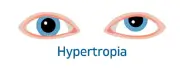 Squint hypotropia