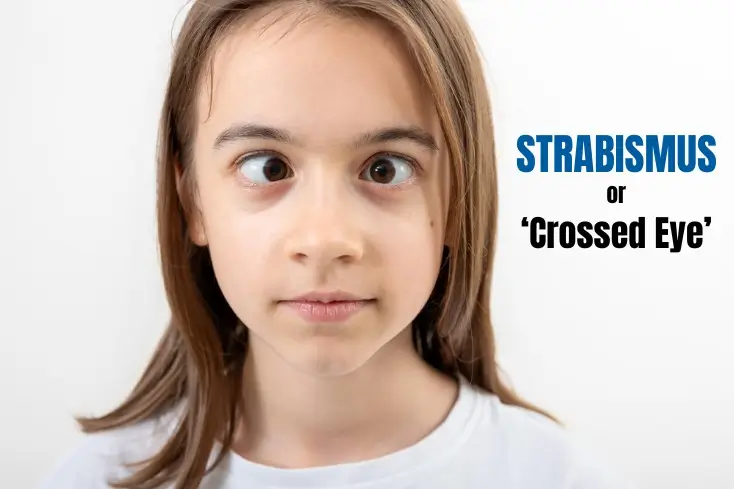 Strabismus eye