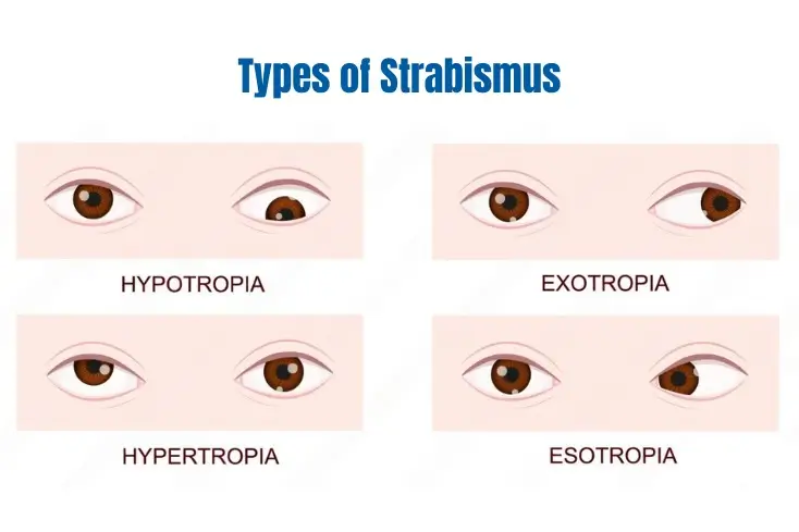 Types of strabismus