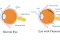 what are eye floaters?