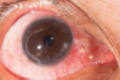 Fungal Keratitis Treatment