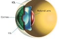 ICL Surgery in Delhi is Revolutionizing Vision Correction