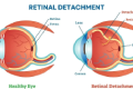 Understanding Retinal Detachments