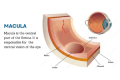 What Are Macular Holes and Tears