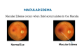 Macular Edema: Understanding, Treatment, and Prevention
