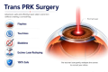 Trans prk lasik surgery in delhi