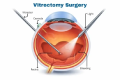 Vitrectomy surgery