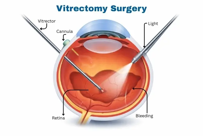 Vitrectomy surgery