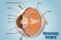 Vitrectomy surgery