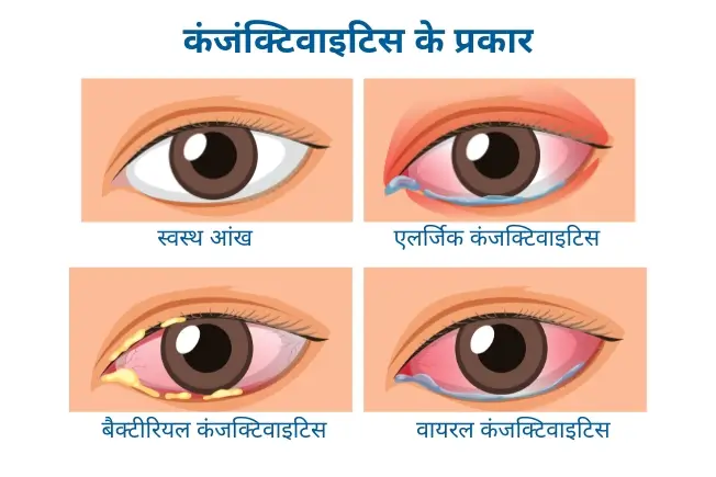 कंजंक्टिवाइटिस के प्रकार
