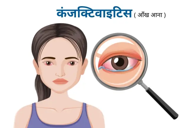 कंजक्टिवाइटिस