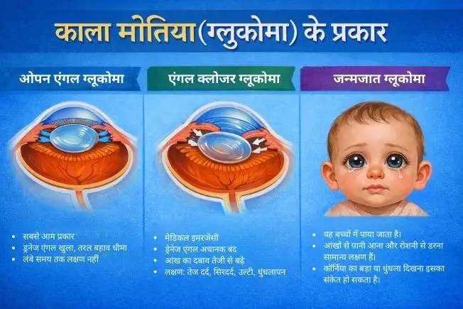 काला मोतिया के प्रकार