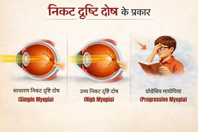 निकट दृष्टि दोष के प्रकार
