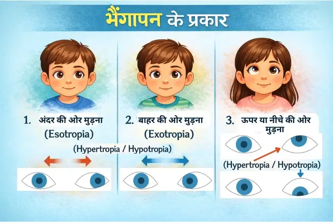 भैंगापन के प्रकार