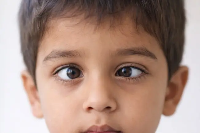 भैंगापन या Squint