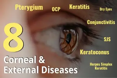 8 Corneal and External Eye Diseases