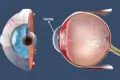 What is cornea