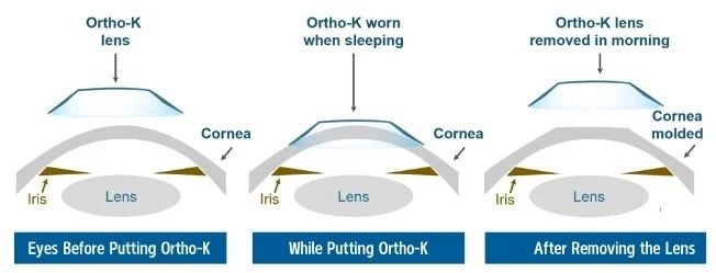 How Do Ortho K Lenses Work