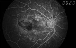is macular degeneration curable