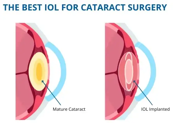 Best iol for cataract surgery