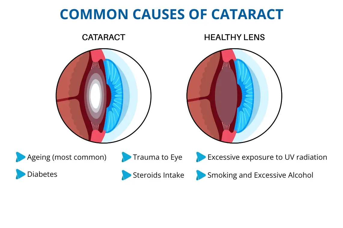 Causes of cataract
