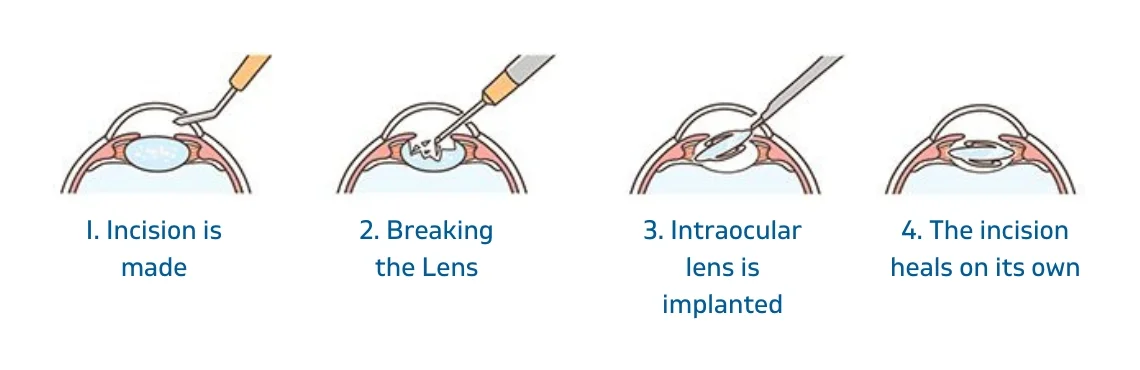 Steps of cataract surgery in delhi
