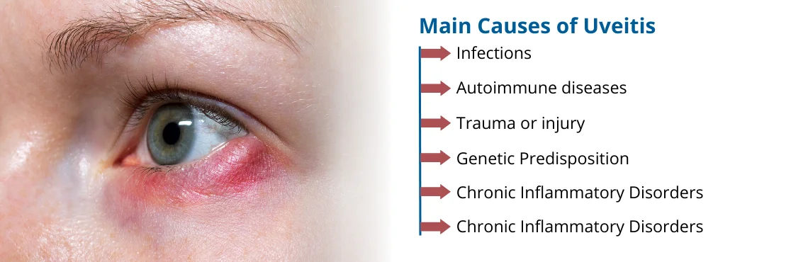 Causes of Uveitis