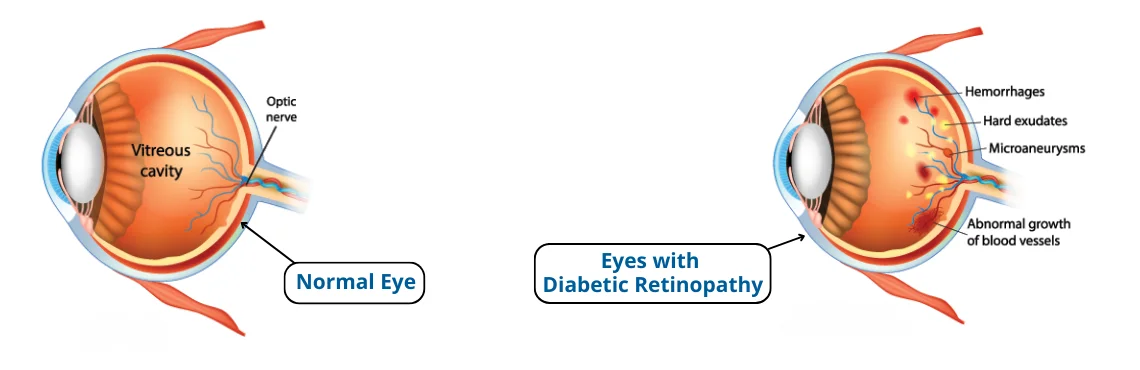 Diabetic Retinopathy Treatment in Delhi