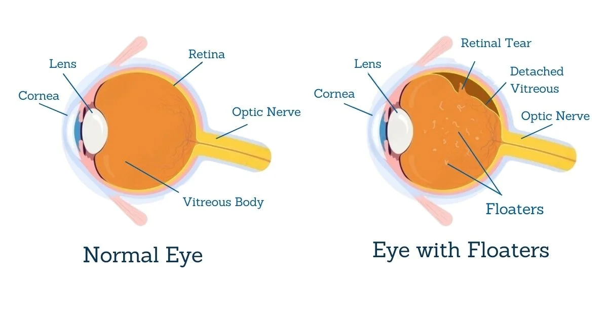 what are eye floaters?