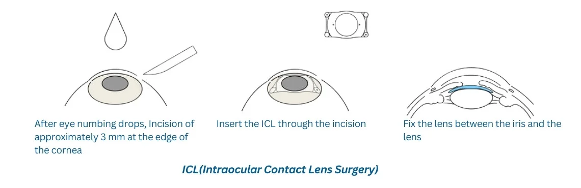 ICL Surgery for glass removal
