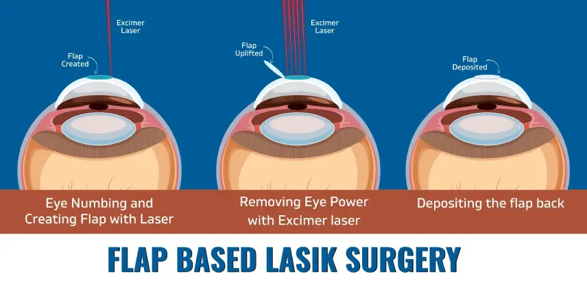 Flap Based LASIK Surgery