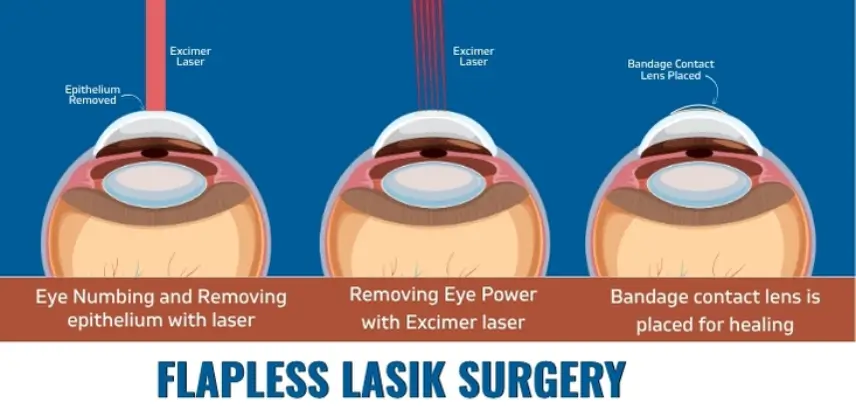 Flapless LASIK Surgery