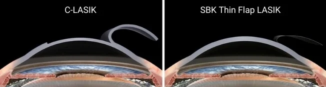 Customized And Sbk Lasik Surgery