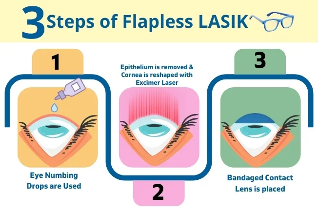 Steps Of Flapless Lasik