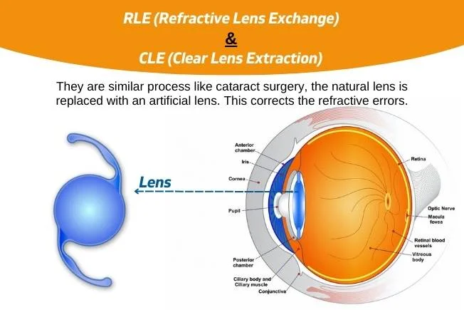 Icl And Ipcl Surgery