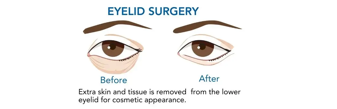Blepharoplasty Eyelid Lift Surgery