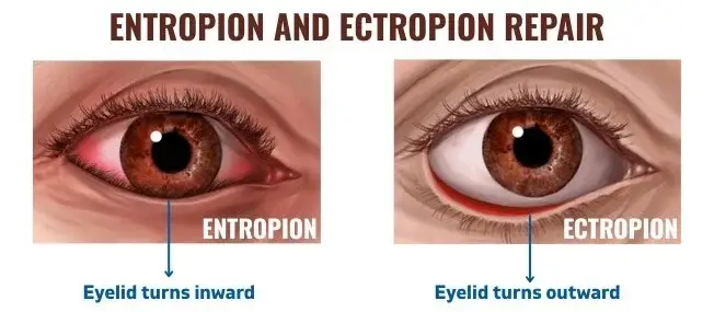 Entropion And Ectropion Repair